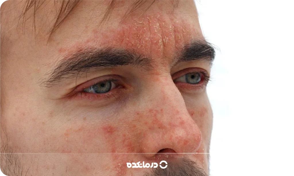 تصویر درماتیت سبورئیک را می بینید