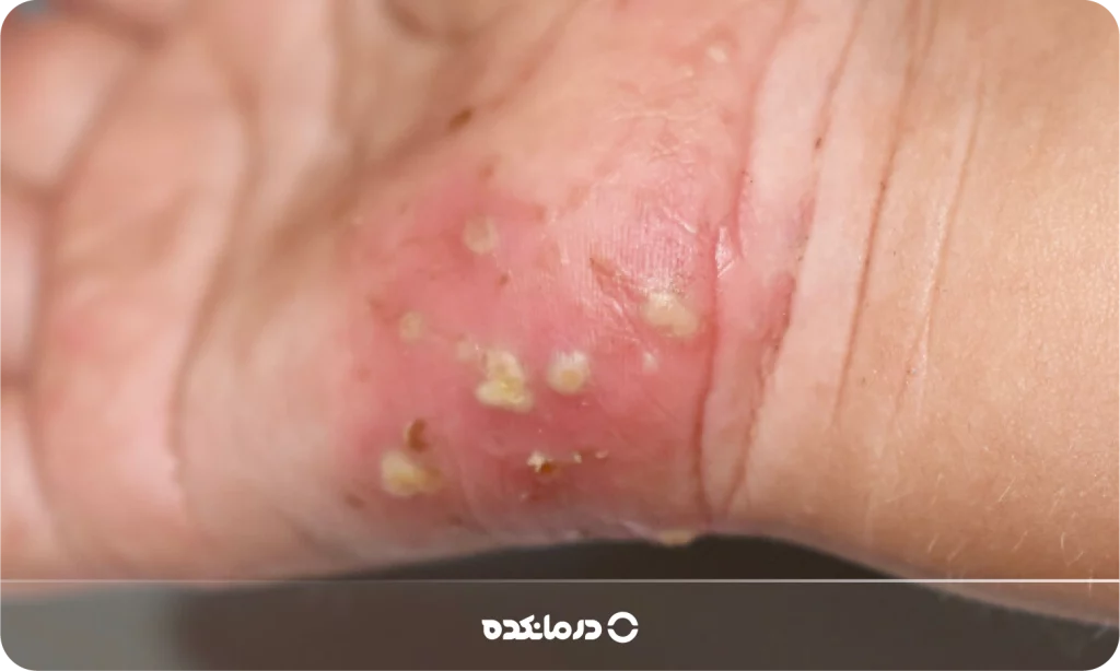 تصویر بیماری گال را می بینید