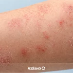 انواع بیماری های پوستی خارش دار [۱۴ بیماری مهم + عکس]