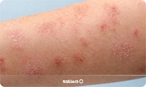 انواع بیماری های پوستی خارش دار [۱۴ بیماری مهم + عکس]