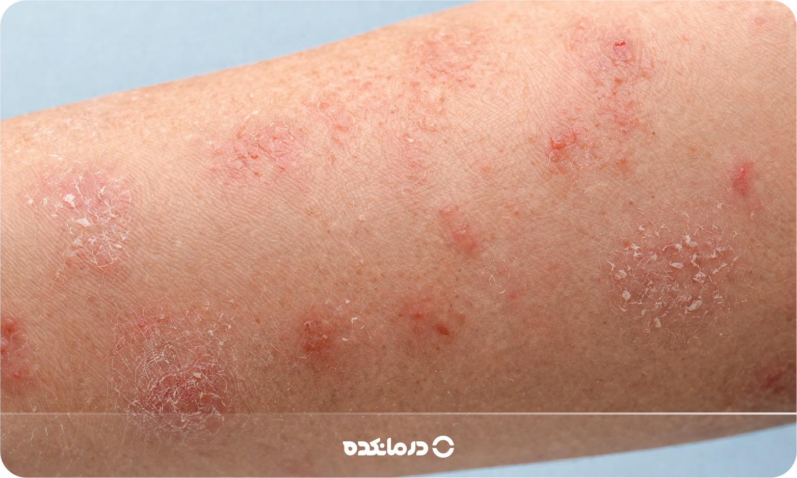 انواع بیماری های پوستی خارش دار [۱۴ بیماری مهم + عکس]