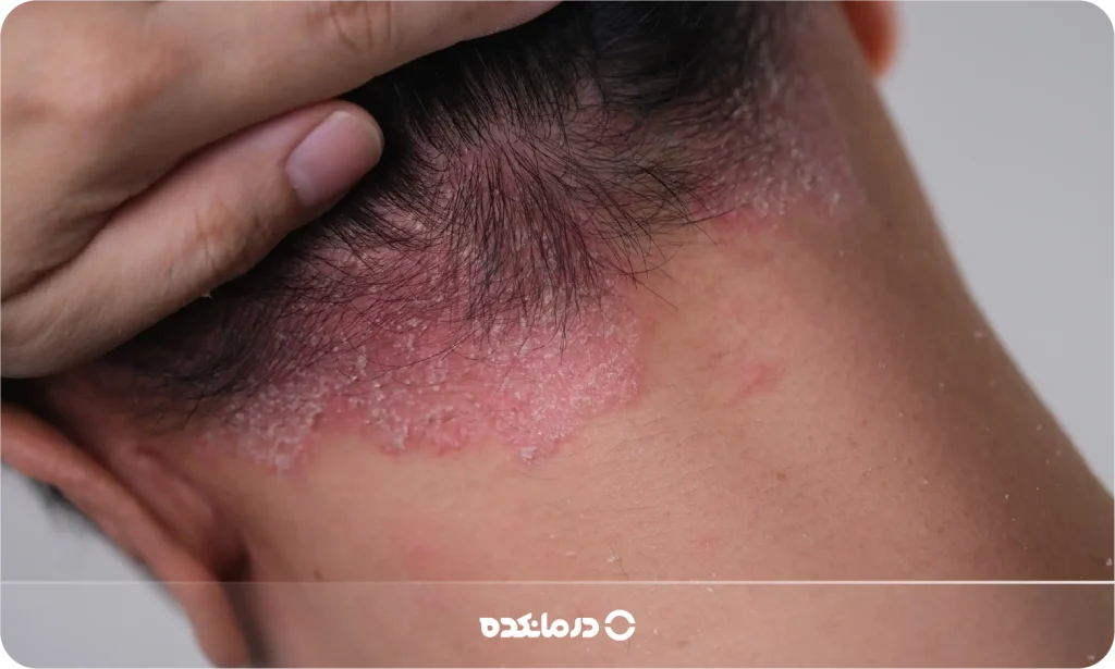 تصویر پسوریازیس را می بینید