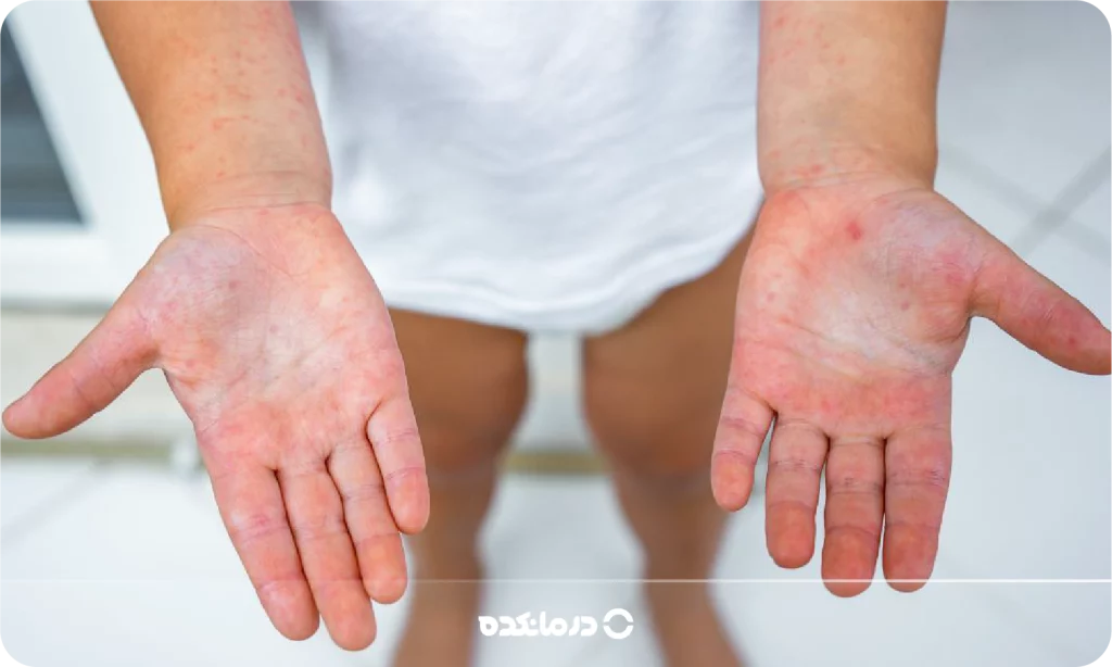 تصویر آلرژی به لاتکس را می بینید