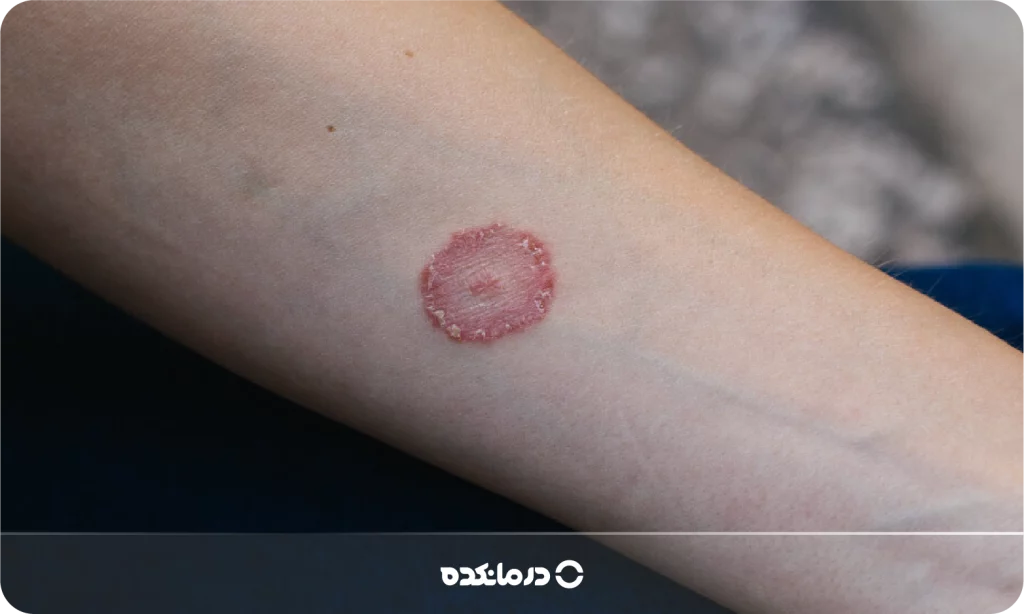 تصویر بیماری کرم حلقوی را می بینید