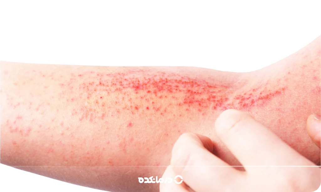 تصویر اگزما را می بینید