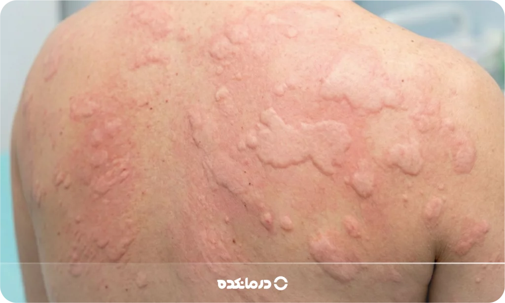 تصویر کهیر  را می بینید