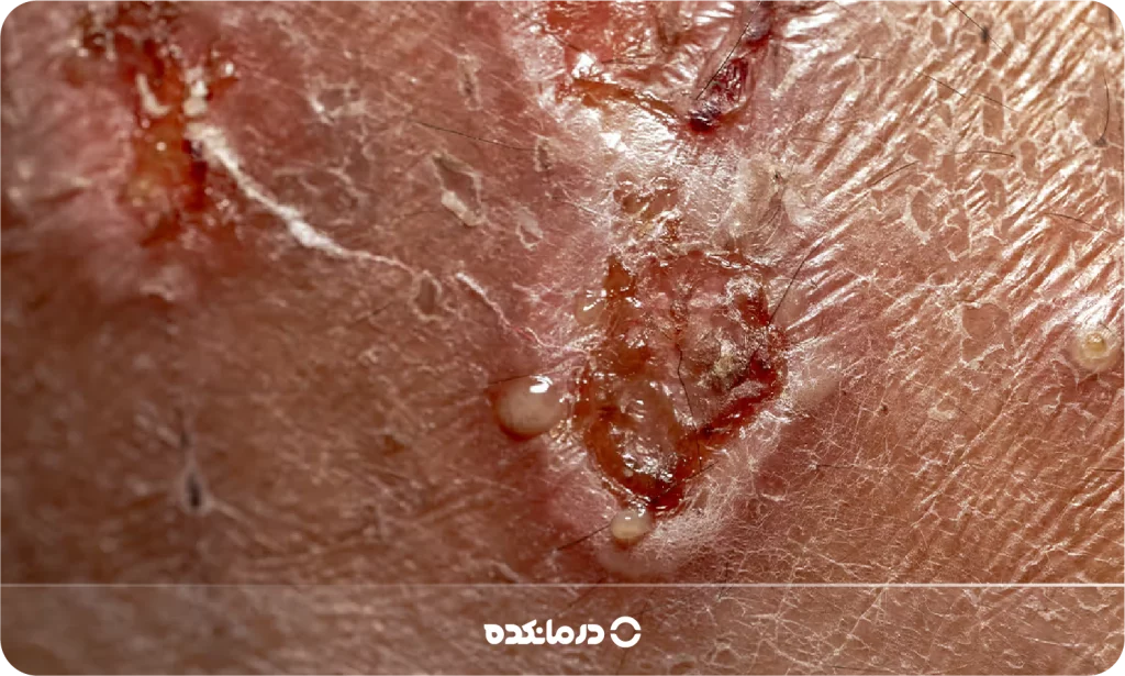 تصویر بیماری لوپوس را می بینید