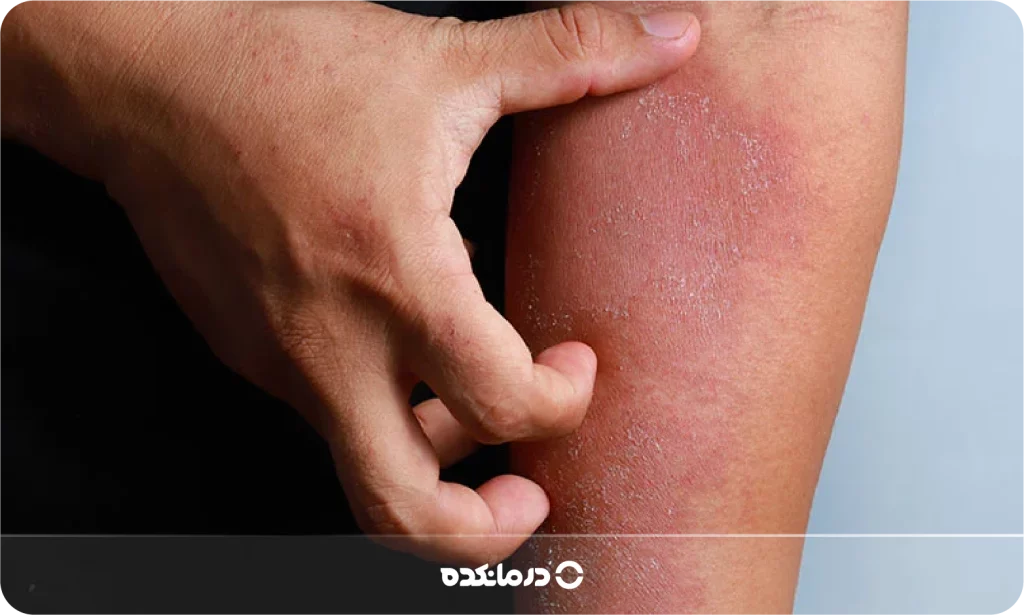 تصویر بیماری لنفوم پوستی را می بینید