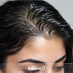 علت و درمان موی چرب [۱۳ راهکار خانگی درمان دائمی و قطعی]