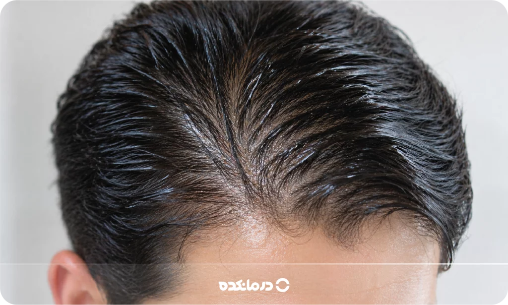 تصویر فردی با موی چرب را می بینید