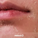 پوسته پوسته شدن صورت و بدن: ۸ علت و درمان + بهترین کرم