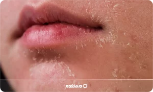 پوسته پوسته شدن صورت و بدن: ۸ علت و درمان + بهترین کرم
