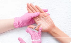 بوتاکس کف دست؛ مزایا و عوارض + مراقبتهای قبل و بعد از درمان