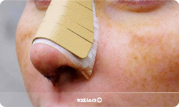 تصویری از اسپلینت بینی خارجی را می بینید