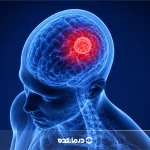 جراحی تومور مغزی چگونه است؟ + انواع، مزایا و عوارض عمل تومور مغز