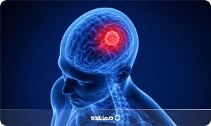 جراحی تومور مغزی چگونه است؟ + انواع، مزایا و عوارض عمل تومور مغز