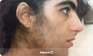 موهای زائد زنان [علت، روش‌های اصلاح و درمان]