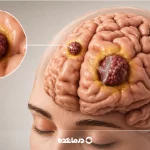 متاستاز مغز چیست؟ دلایل، علائم هشداردهنده و درمان تومور ثانویه مغز