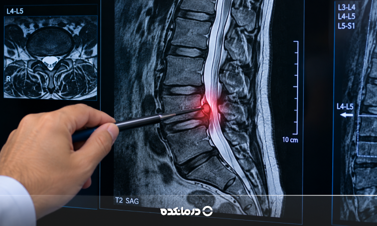 تصویر بیرون‌زدگی دیسک کمر در ام‌آرآی (MRI)
