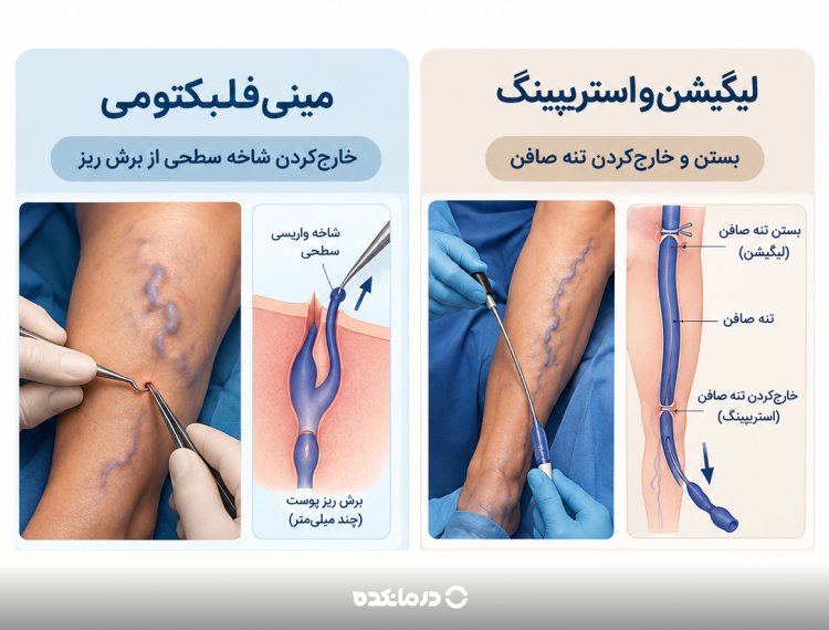 اینفوگرافی تفاوت فلبکتومی با استریپینگ در عمل واریس پا (دو پنل اصلی: مینیفلبکتومی = خارجکردن شاخه سطحی از برش ریز؛ لیگیشن و استریپینگ = بستن و خارجکردن تنه صافن.)