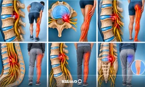خطرناکترین دیسک کمر کدام است؟ ۶ نشانه هشدار که باید جدی بگیرید