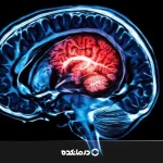 عوارض بعد از سکته مغزی خفیف و شدید چیست؟ بررسی ۱۵ پیامد مهم