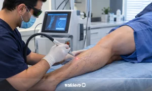 لیزر واریس پا چگونه انجام میشود؟ مراحل، مزایا، عوارض و مراقبت ها