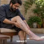 علت واریس پا در جوانی؛ آیا رگهای برجسته در سن پایین خطرناک هستند؟