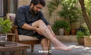 علت واریس پا در جوانی؛ آیا رگهای برجسته در سن پایین خطرناک هستند؟