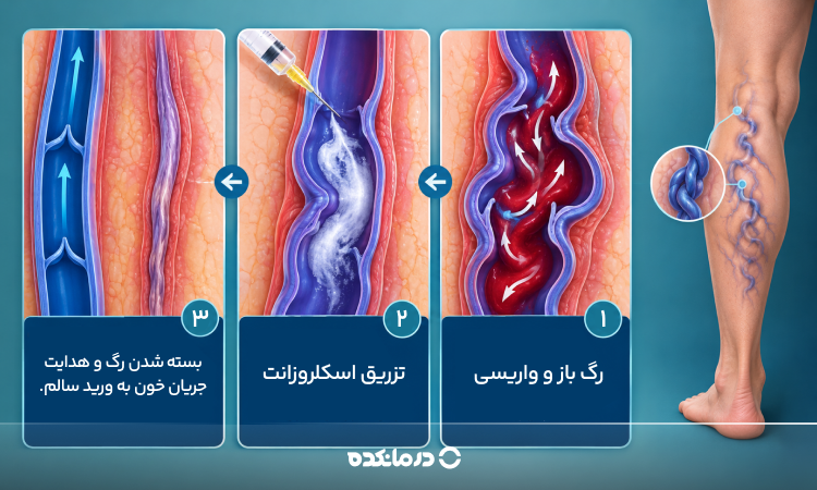 نحوه اثر اسکلروتراپی روی رگ واریسی را می بینید