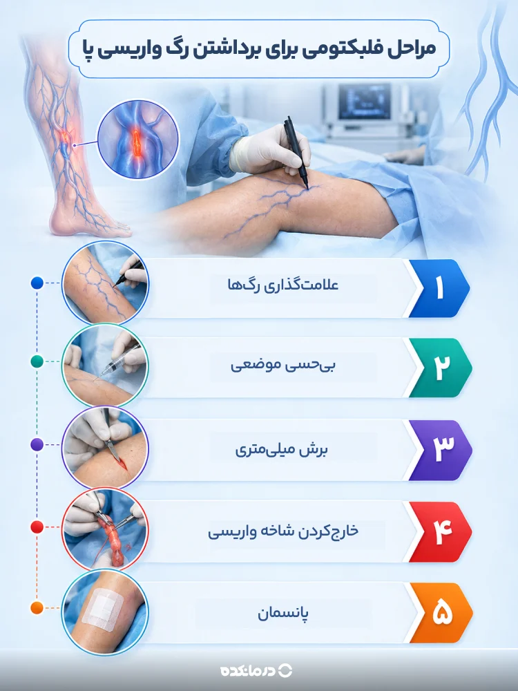 اینفوگرافی مراحل فلبکتومی برای برداشتن رگ واریسی پا (اشاره به علامت‌گذاری رگ‌ها، بی‌حسی موضعی، برش میلی‌متری، خارج‌کردن شاخه واریسی، پانسمان)