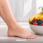 برای درمان واریس چه بخوریم؟ ۲۴ خوراکی مفید برای واریس پا + غذاهای مضر
