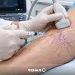 اسکلروتراپی واریس چیست؟ نحوه انجام، مزایا، عوارض و مراقبت‌ها